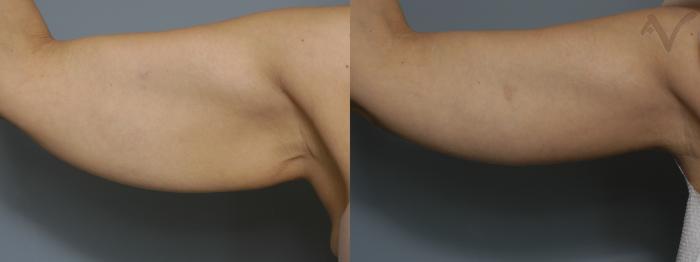 Before & After Arm Lift Case 18 Right Side View in Los Angeles, CA