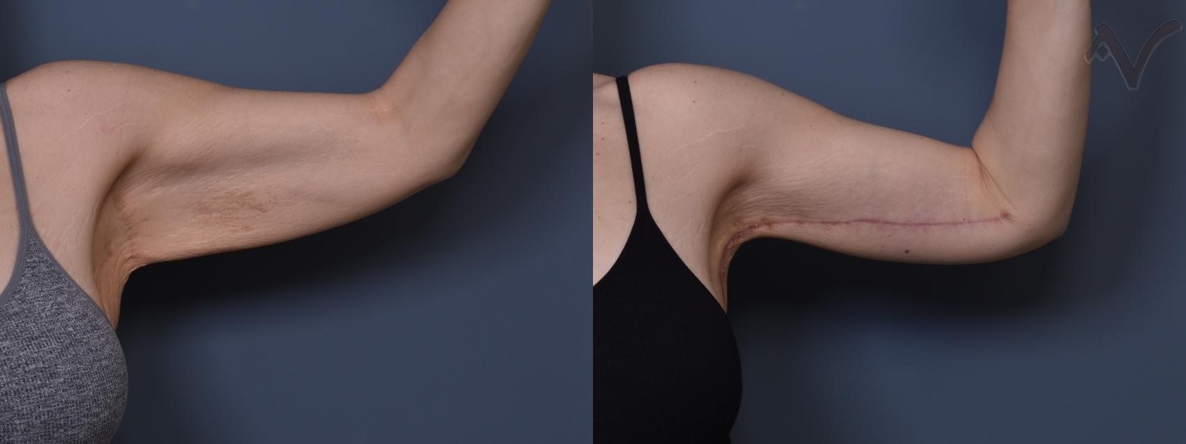 Before & After Arm Lift Case 434 Left Side View in Los Angeles, CA