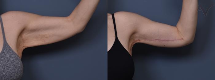 Before & After Arm Lift Case 434 Left Side View in Los Angeles, CA
