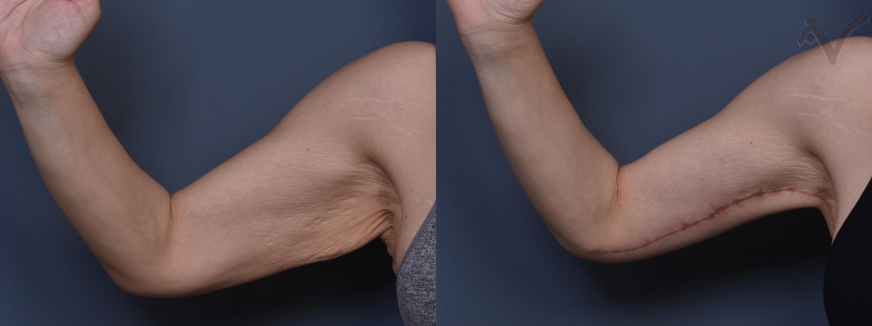 Before & After Arm Lift Case 434 Right Side View in Los Angeles, CA