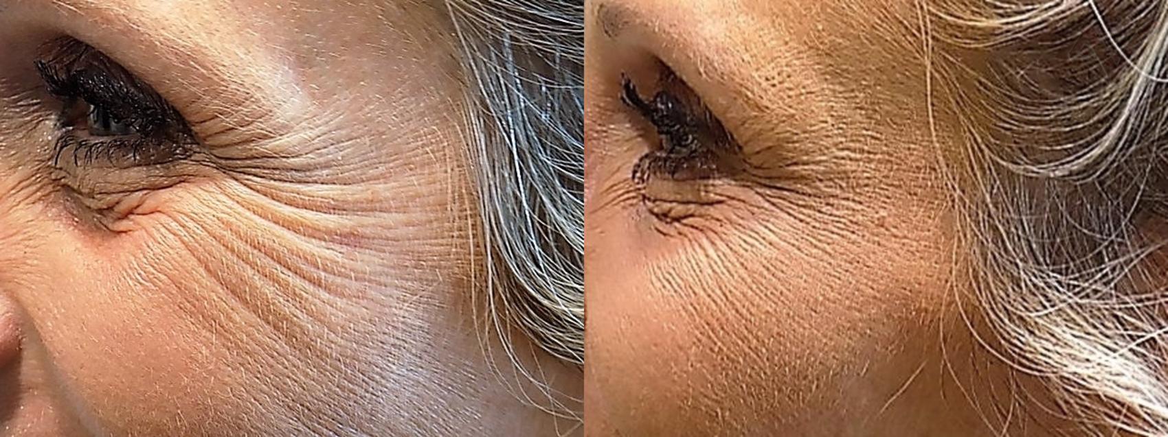 Before & After Botulinum ToxinA (BOTOX®| Dysport®) Case 49 Left Side View in Burbank, CA