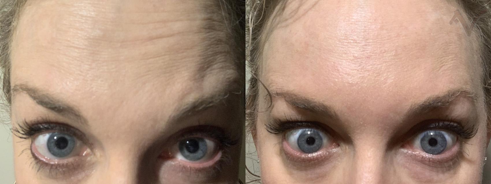 Before & After Botulinum ToxinA (BOTOX®| Dysport®) Case 50 Forehead View in Burbank, CA