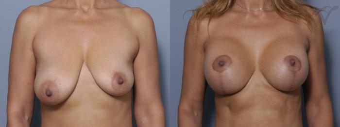 Before & After Breast Asymmetry Case 103 Front View in Los Angeles, CA