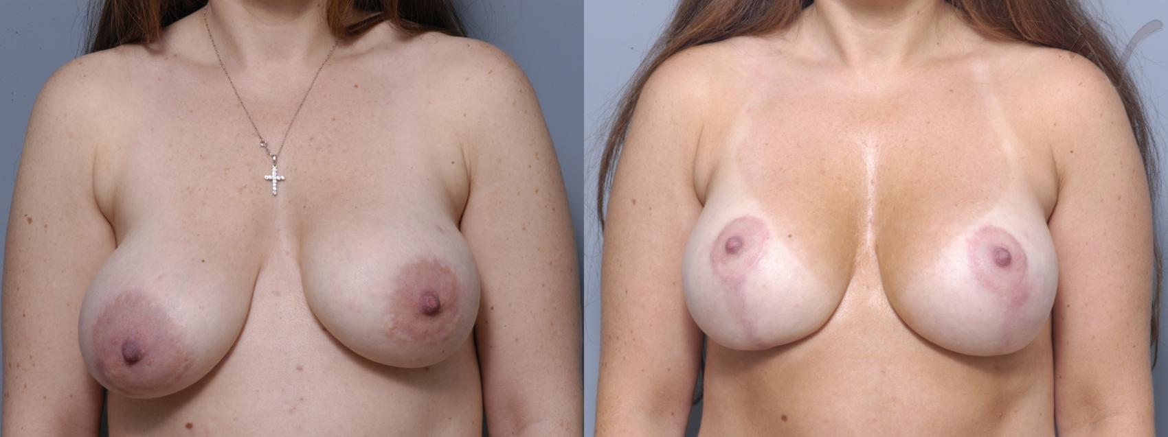 Before & After Breast Asymmetry Case 104 Front View in Burbank, CA