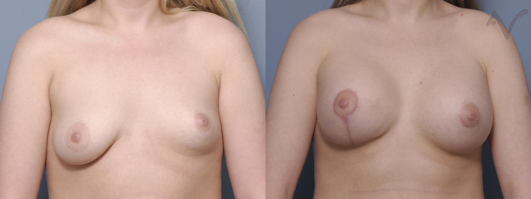 Before & After Breast Asymmetry Case 105 Front View in Burbank, CA