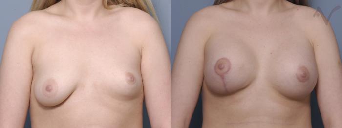 Before & After Breast Asymmetry Case 105 Front View in Los Angeles, CA