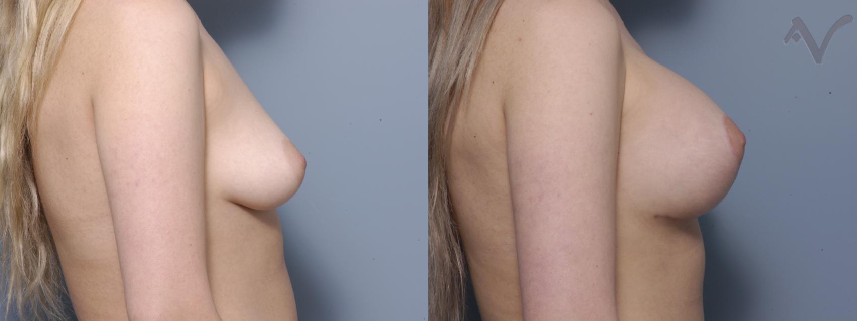 Before & After Breast Asymmetry Case 105 Right Side View in Burbank, CA