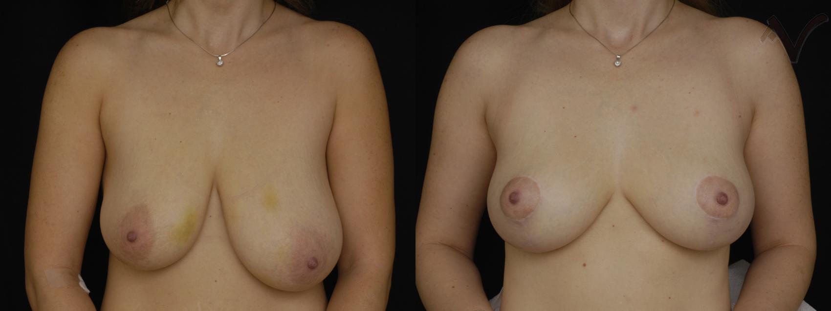 Before & After Breast Asymmetry Case 106 Front View in Los Angeles, CA