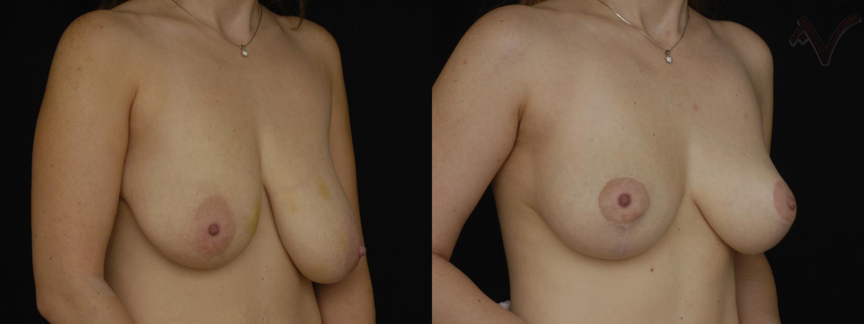 Before & After Breast Asymmetry Case 106 Right Oblique View in Burbank, CA