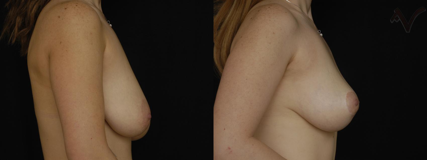 Before & After Breast Asymmetry Case 106 Right Side View in Burbank, CA