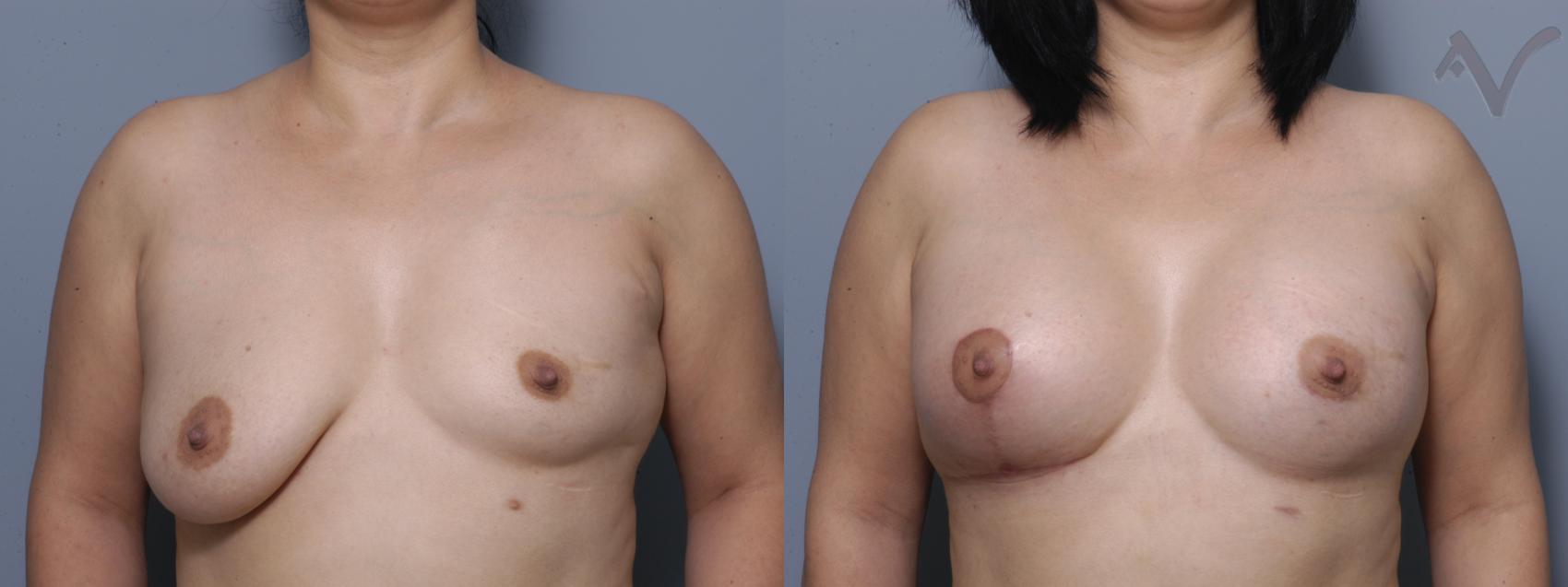 Before & After Breast Augmentation with Lift Case 107 Front View in Los Angeles, CA