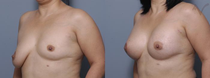 Before & After Breast Augmentation with Lift Case 107 Right Oblique View in Los Angeles, CA