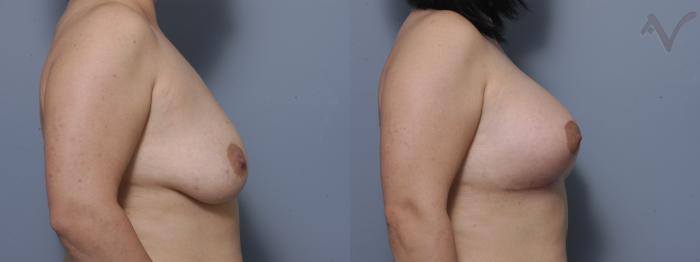 Before & After Breast Augmentation with Lift Case 107 Right Side View in Los Angeles, CA