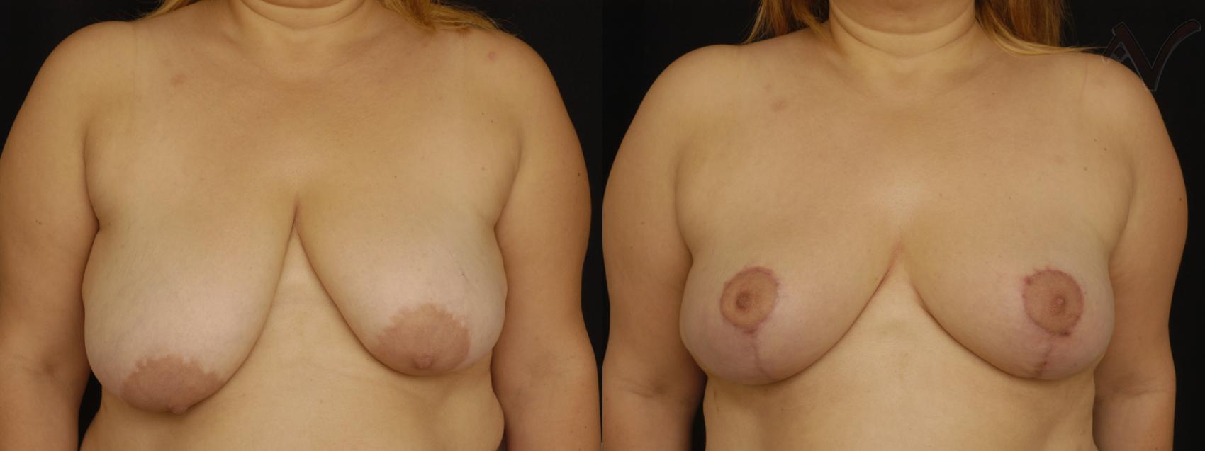 Before & After Breast Reduction Case 108 Front View in Los Angeles, CA