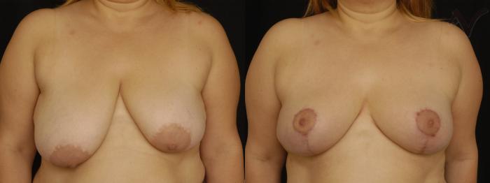 Before & After Breast Asymmetry Case 108 Front View in Los Angeles, CA