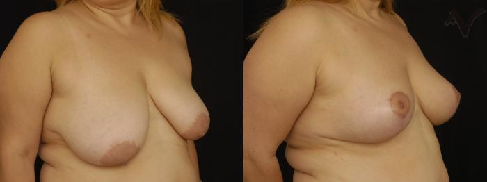 Before & After Breast Asymmetry Case 108 Right Oblique View in Los Angeles, CA