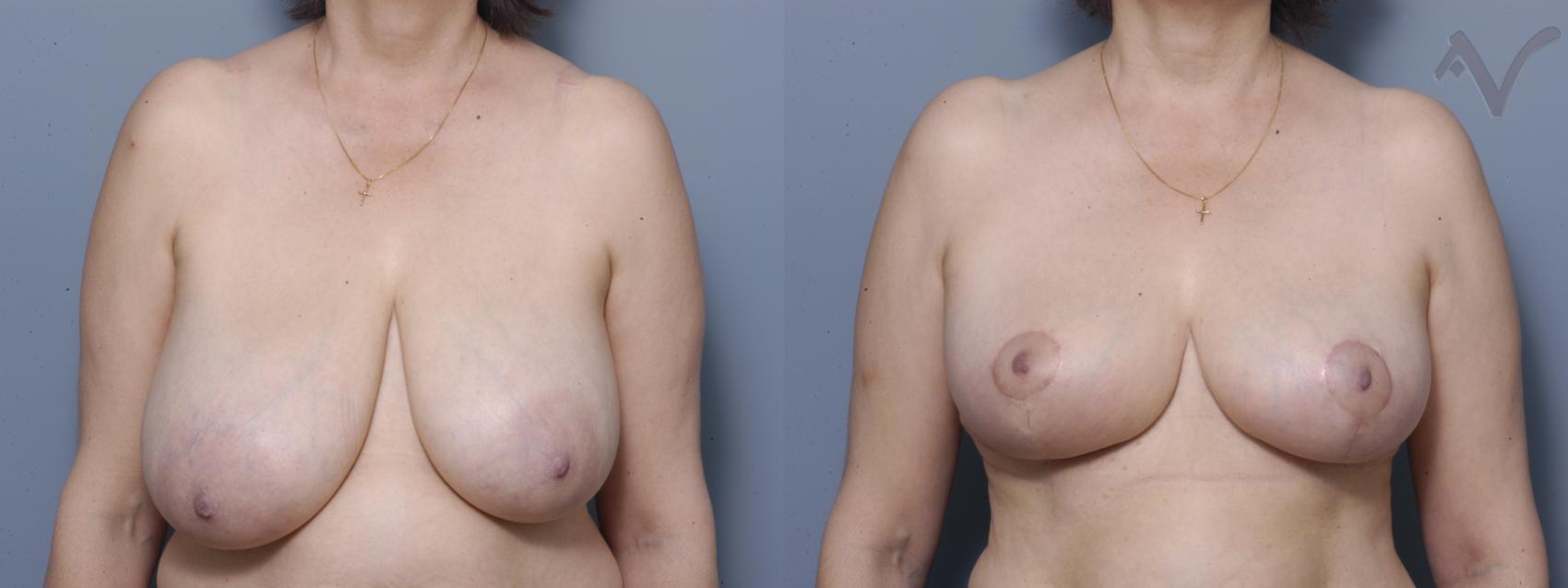 Before & After Breast Asymmetry Case 109 Front View in Burbank, CA