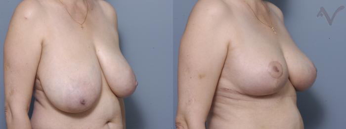 Before & After Breast Asymmetry Case 109 Right Oblique View in Los Angeles, CA