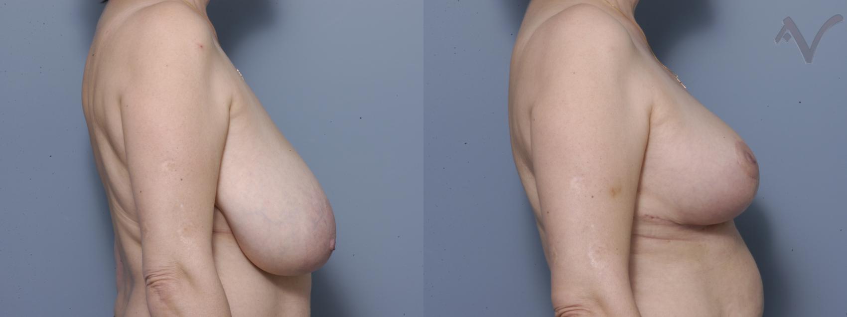 Before & After Breast Asymmetry Case 109 Right Side View in Burbank, CA