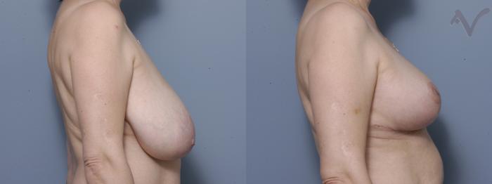Before & After Breast Asymmetry Case 109 Right Side View in Los Angeles, CA