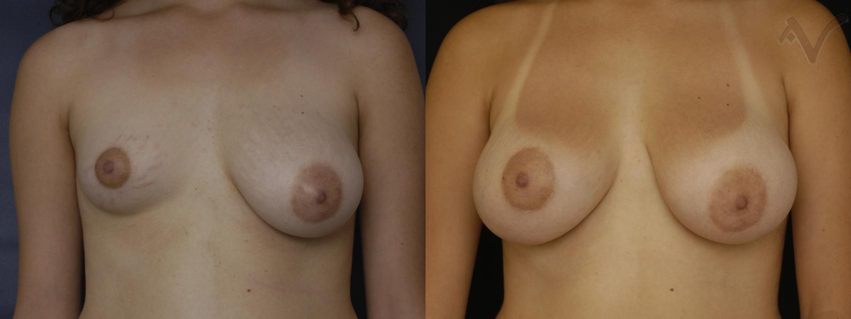 Before & After Breast Augmentation Case 110 Front View in Los Angeles, CA