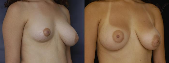 Before & After Breast Augmentation Case 110 Right Oblique View in Los Angeles, CA