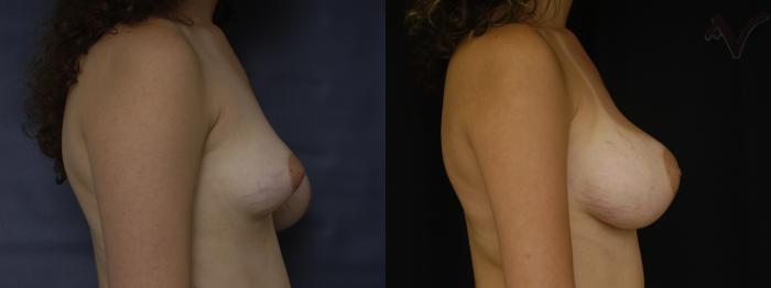 Before & After Breast Asymmetry Case 110 Right Side View in Los Angeles, CA