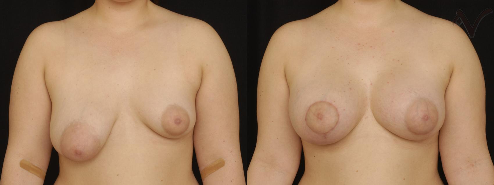 Before & After Breast Augmentation with Lift Case 111 Front View in Los Angeles, CA