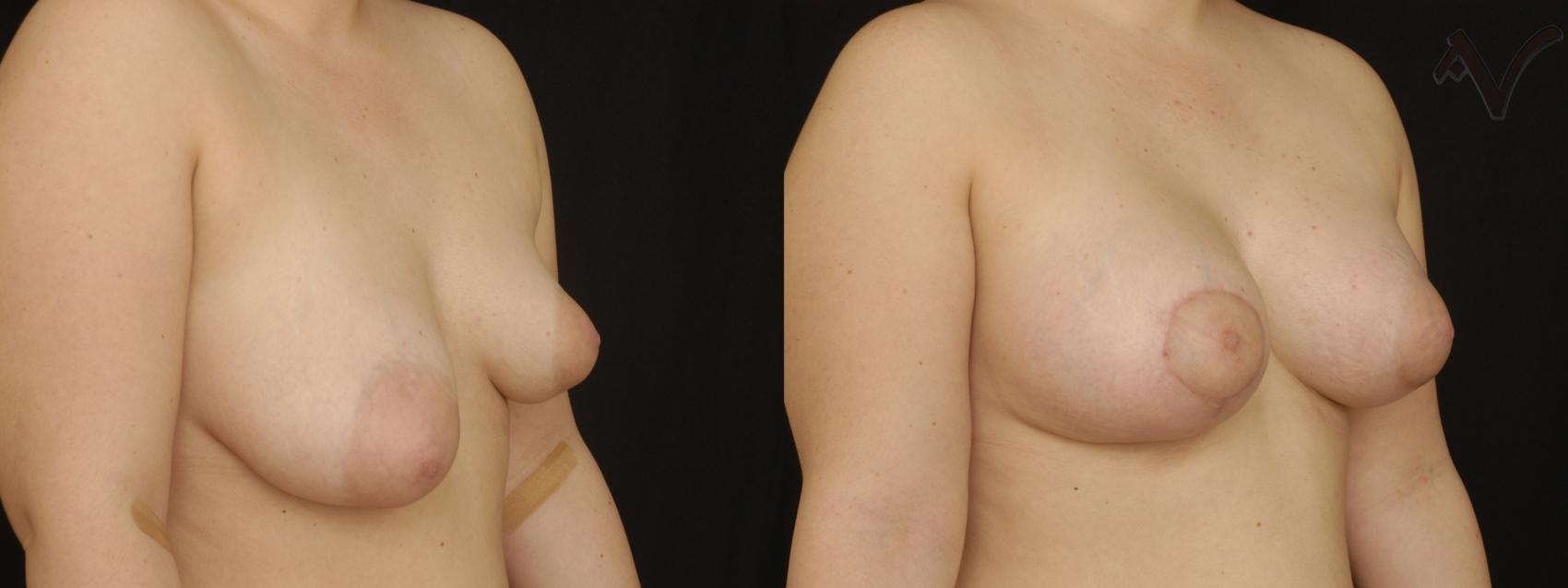 Before & After Breast Asymmetry Case 111 Right Oblique View in Los Angeles, CA