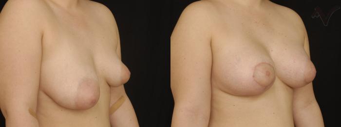 Before & After Breast Augmentation with Lift Case 111 Right Oblique View in Los Angeles, CA