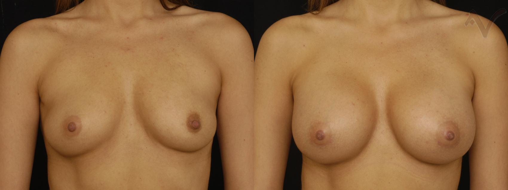 Before & After Breast Augmentation Case 121 Front View in Burbank, CA