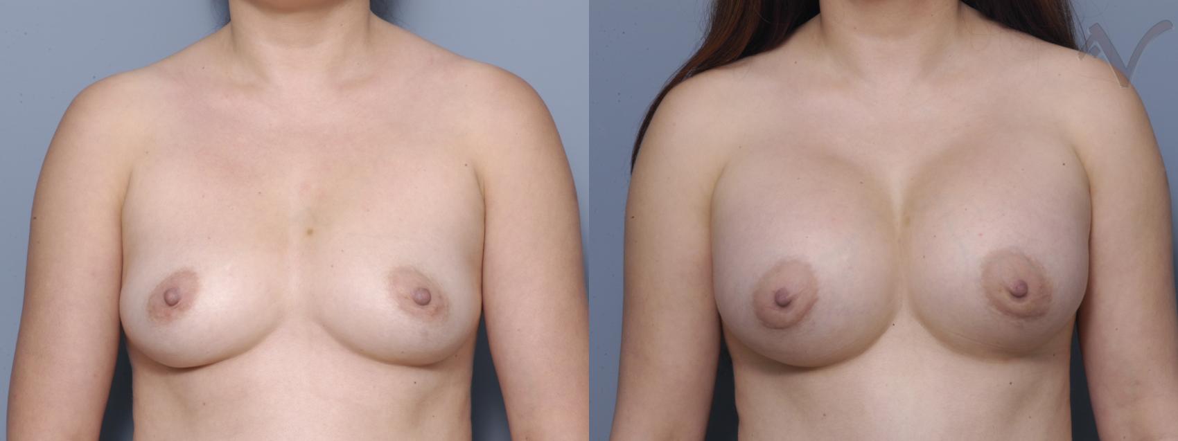 Before & After Breast Augmentation Case 122 Front View in Los Angeles, CA