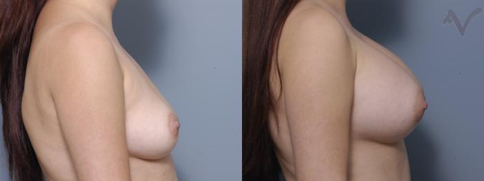 Before & After Breast Augmentation Case 122 Right Side View in Los Angeles, CA