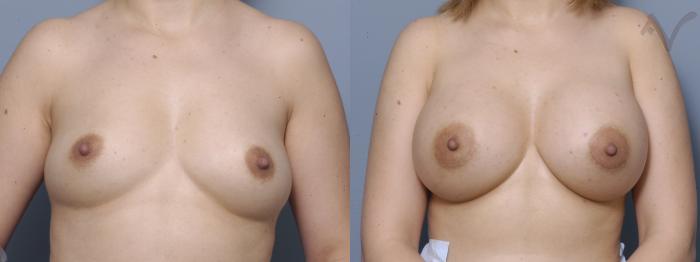 Before & After Breast Augmentation Case 127 Front View in Los Angeles, CA