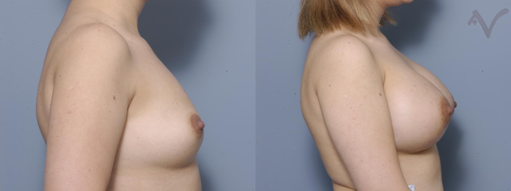 Before & After Breast Augmentation Case 127 Right Side View in Burbank, CA