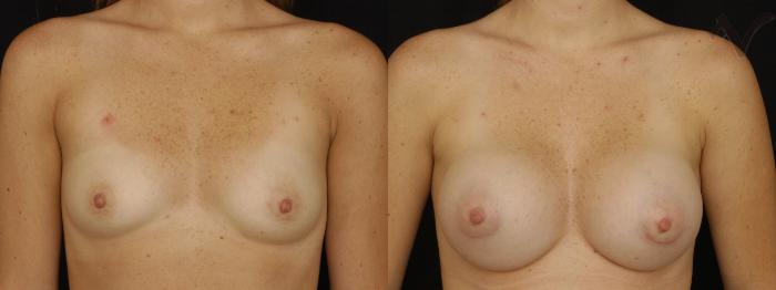 Before & After Breast Augmentation Case 129 Front View in Los Angeles, CA