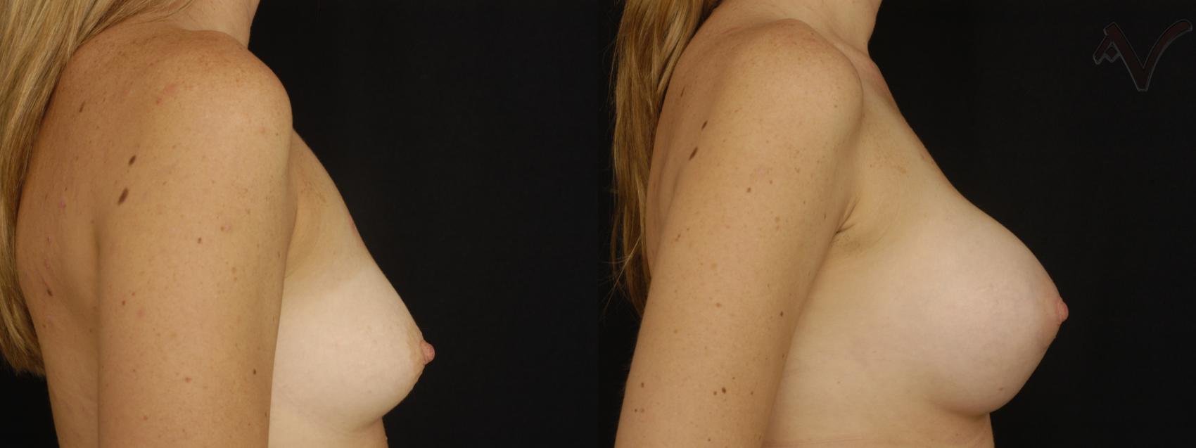 Before & After Breast Augmentation Case 129 Right Side View in Los Angeles, CA