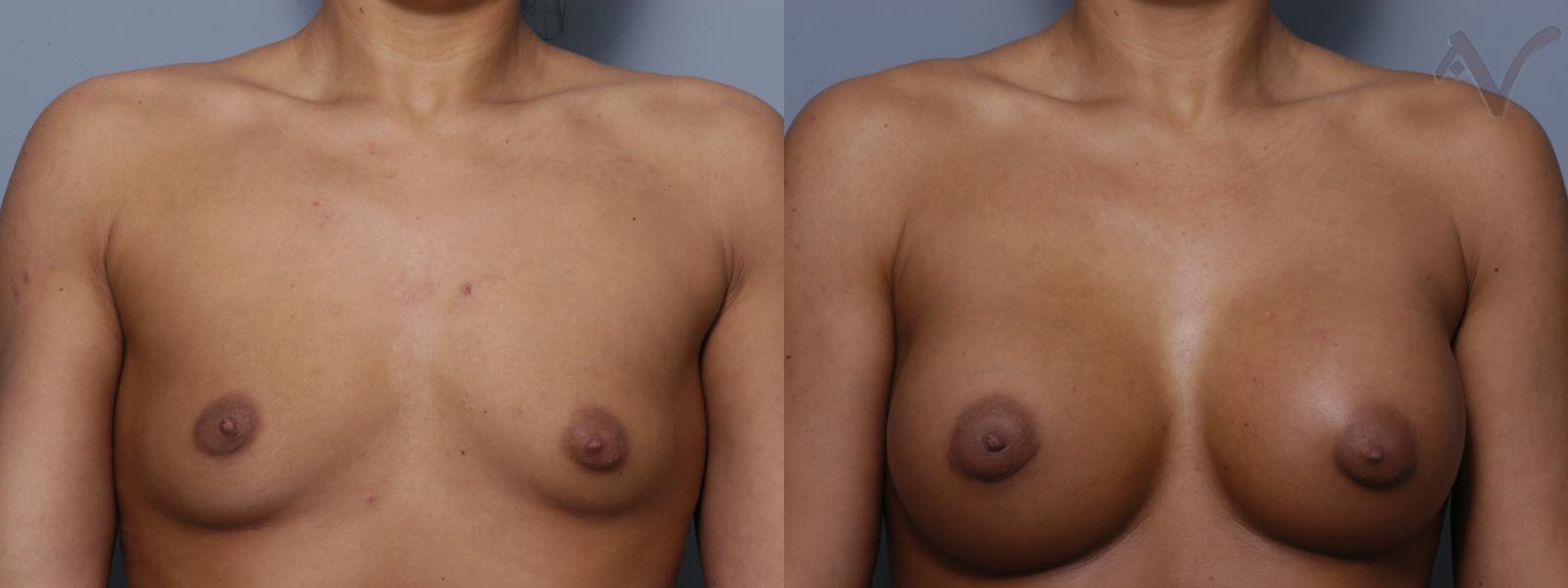 Before & After Breast Augmentation Case 131 Front View in Los Angeles, CA