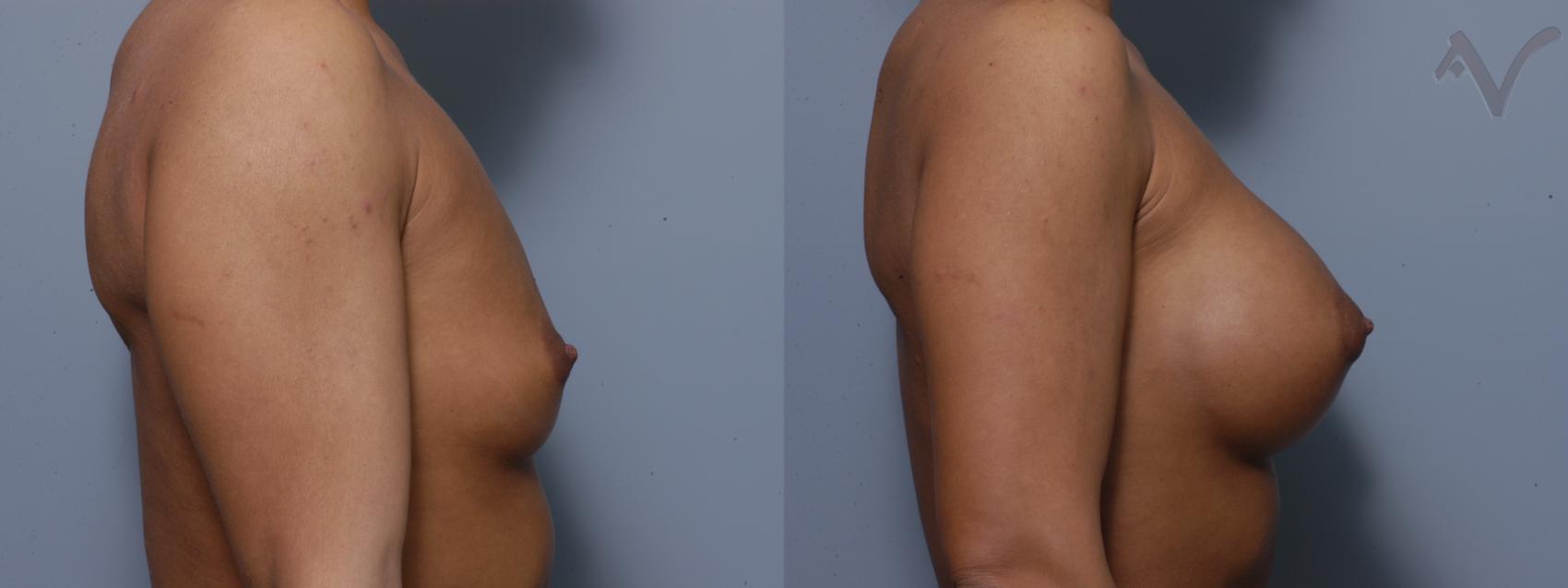 Before & After Breast Augmentation Case 131 Right Side View in Los Angeles, CA