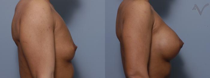 Before & After Breast Augmentation Case 131 Right Side View in Los Angeles, CA
