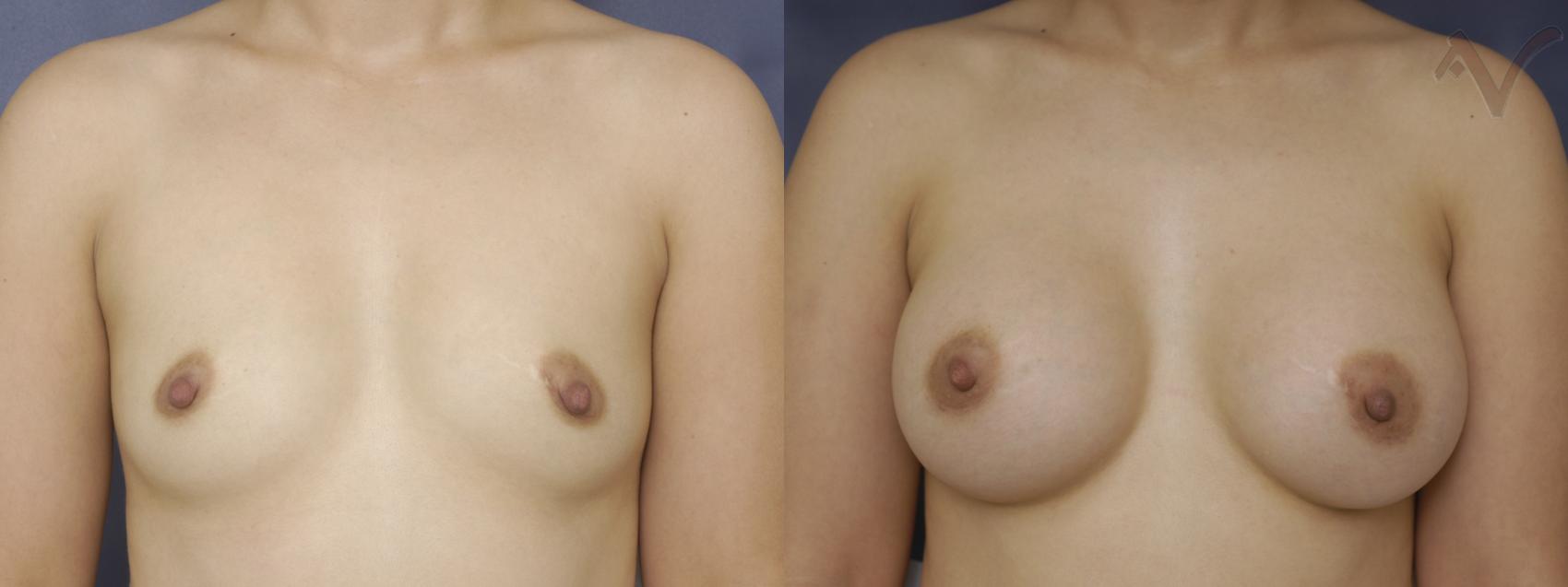 Before & After Breast Augmentation Case 133 Front View in Los Angeles, CA