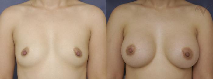 Before & After Breast Augmentation Case 133 Front View in Los Angeles, CA