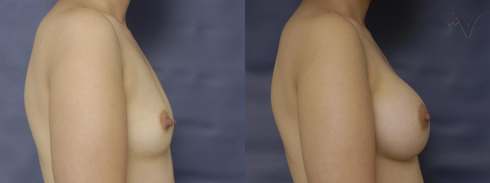 Before & After Breast Augmentation Case 133 Right Side View in Los Angeles, CA