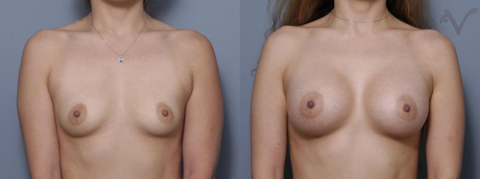 Before & After Breast Augmentation Case 134 Front View in Los Angeles, CA