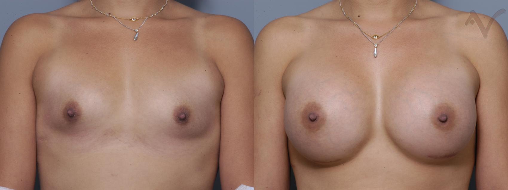 Before & After Breast Augmentation Case 135 Front View in Burbank, CA