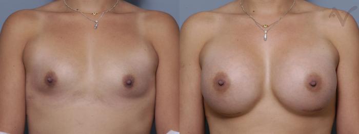 Before & After Breast Augmentation Case 135 Front View in Los Angeles, CA