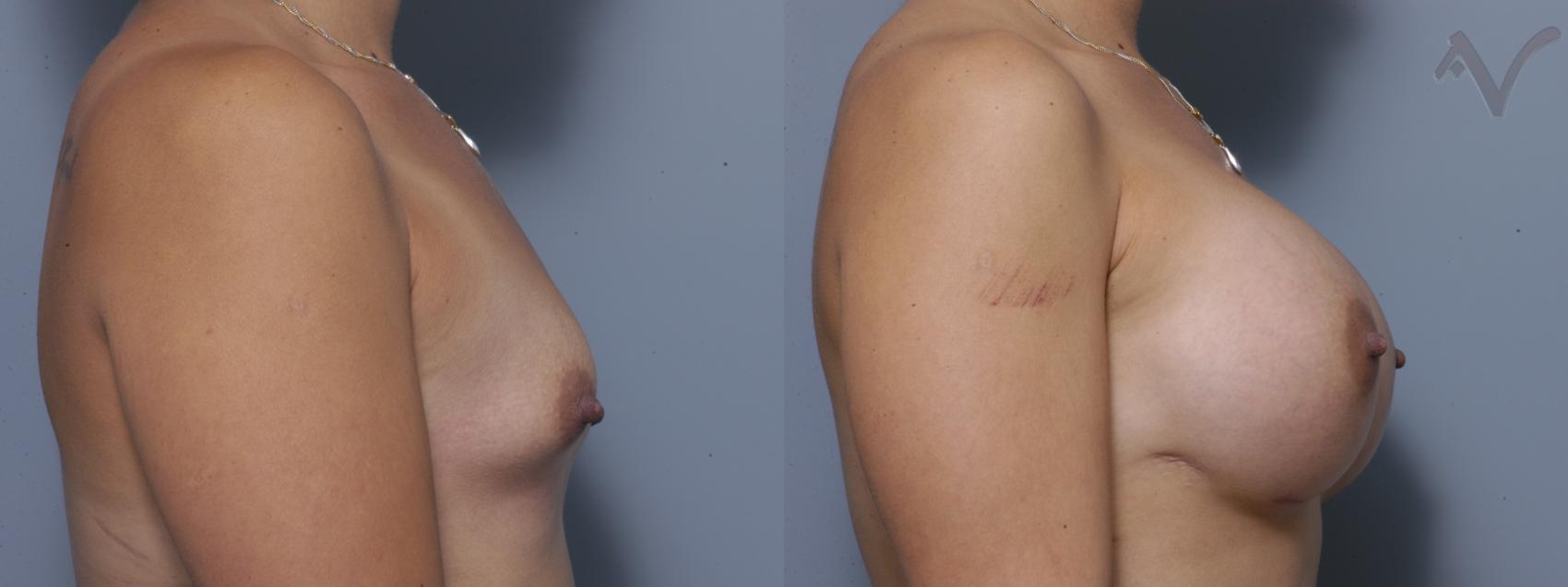 Before & After Breast Augmentation Case 135 Right Side View in Burbank, CA