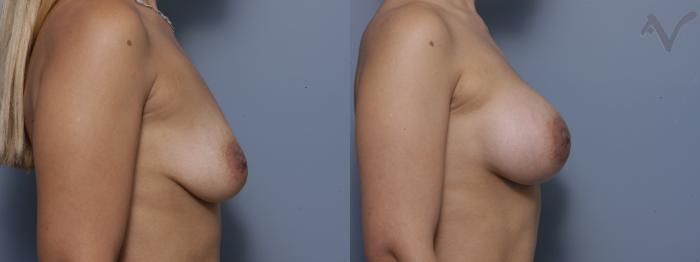 Before & After Breast Augmentation Case 136 Right Side View in Los Angeles, CA