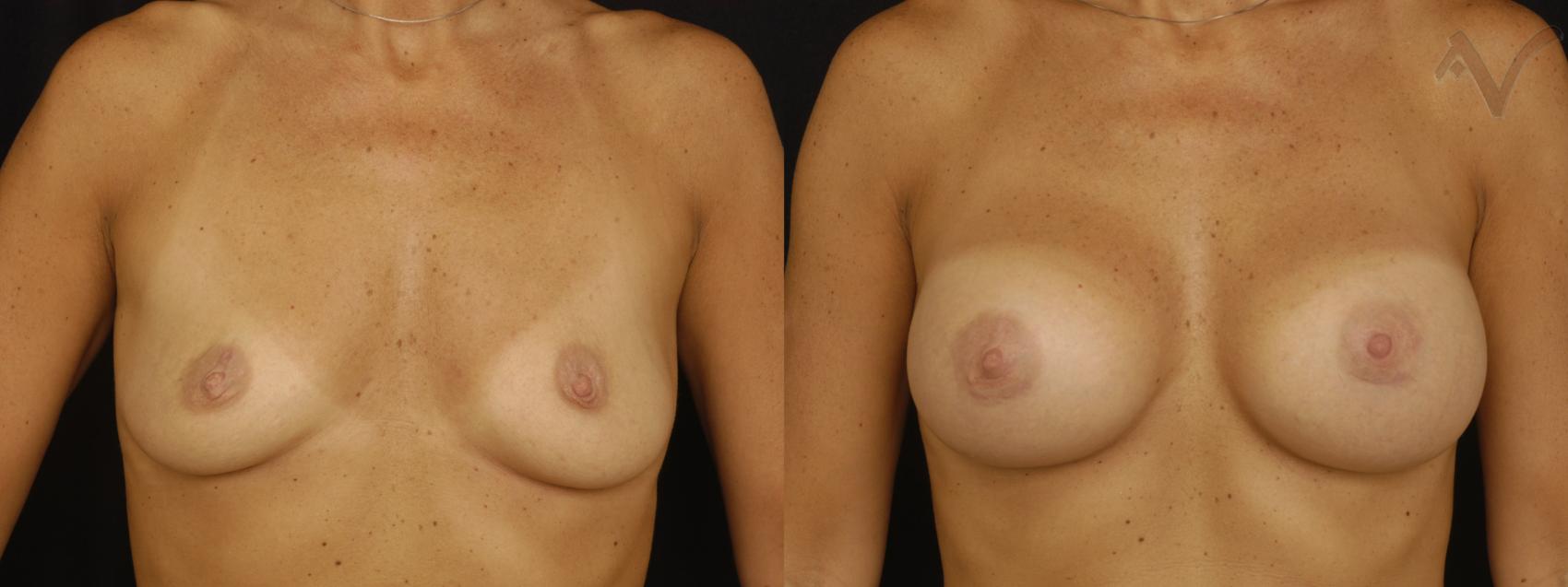 Before & After Breast Augmentation Case 137 Front View in Los Angeles, CA