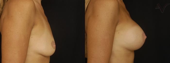 Before & After Breast Augmentation Case 137 Right Side View in Los Angeles, CA